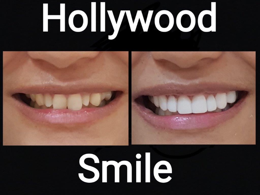 hollywood smile