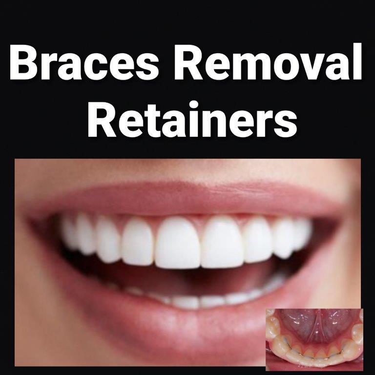 remove braces